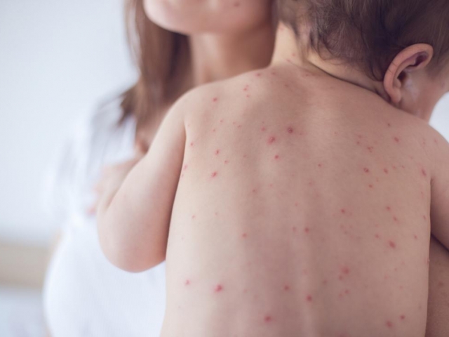 0 Never Seen Measles? 5 Things to Know